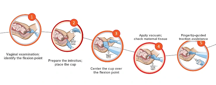 The Kiwi 5-step vacuum-assisted delivery technique